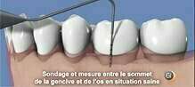 Les 6 étapes du traitement de la parodontite