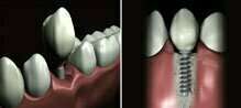 Cas clinique : Les implants dentaires