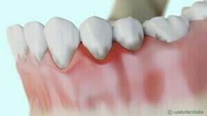 PARODONTITE ET FORMATION D'UNE POCHE PARODONTALE