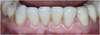 Résultat final, 5 facettes céramiques Emax mandibulaires