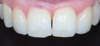 Le sourire est naturel et plus présent Les diastèmes sont refermés par 2 facettes céramique sur les incisives latérales et une stratification de composite sur la canine gauche