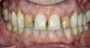 Cas 9 : Eclaircissement dentaire, pose de 2 facettes céramiques ainsi que 2 couronnes céramiques Avant