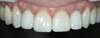 Cas 9 : Eclaircissement dentaire, pose de 2 facettes céramiques ainsi que 2 couronnes céramiques après