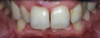 Anomalie de proportion des dents. Cas clinique 4 : pose de facettes céramiques sur les incisives latérales pour l'esthétique.