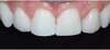 Résultat final associant 2 facettes et 2 stratifications composite sur incisives. Cas clinique 1 : sourire harmonieux.