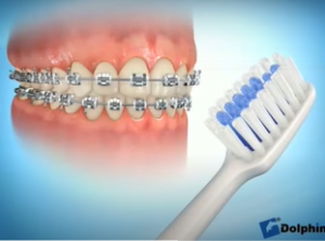 Brossage des dents avec des brackets