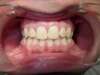 Classe 1, diastème et supra - après