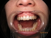 Dents avec dyschromies