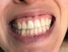 Dents avec dyschromies après pose facettes