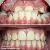 Traitement Orthodontique MultiBagues cas 1