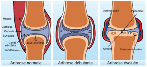 Arthrose et ostéopathie