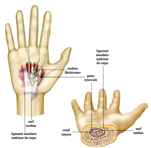 Ostéopathie : le syndrome du canal carpien