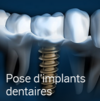 Implants