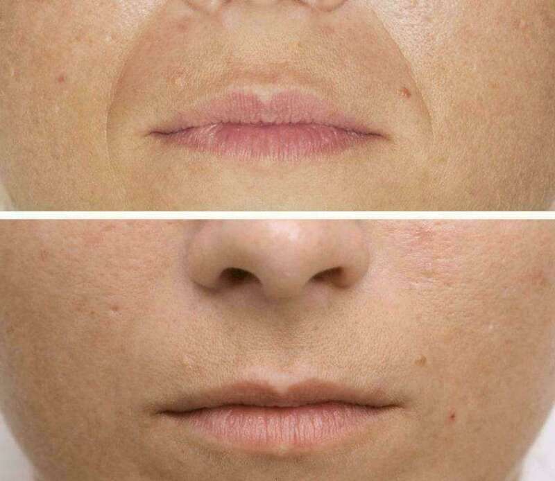 lart_du_visage_1-3-soins-microneedling_2-min_220240120-1876754-1p0avw4