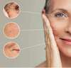microneedling à Bourg-la-Reine