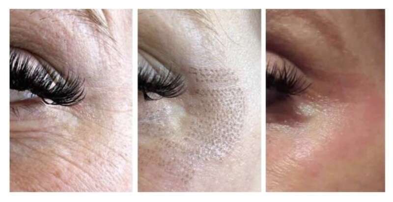 skinlift_pattes_d_oie_avant_apres
