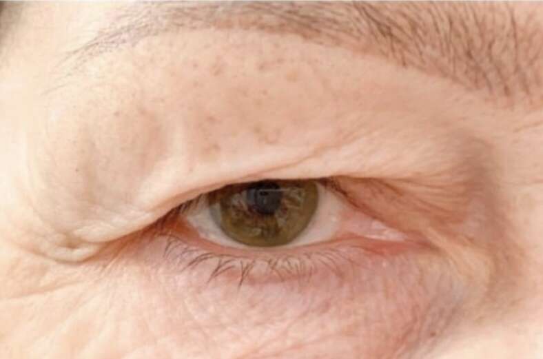 skinlift_paupieres_superieures_avant