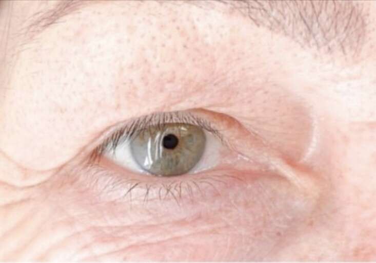skin_lift_paupieres_superieures_resultats