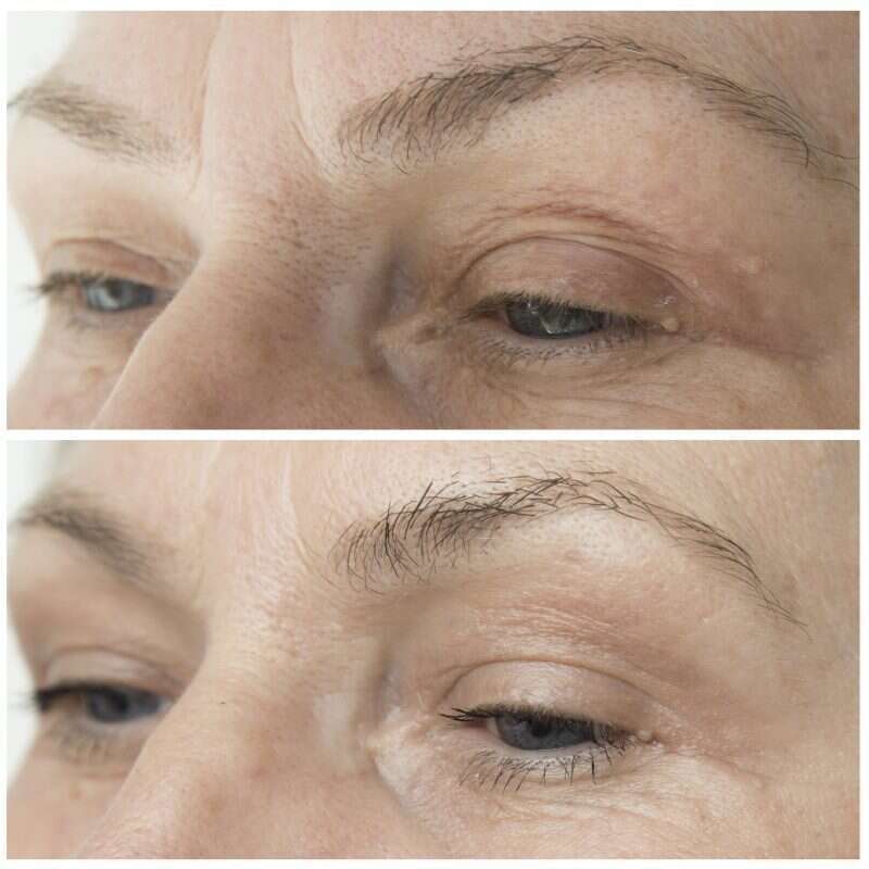 protocole_peeling_et_skinbooster_avant_apres_regard