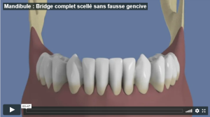 Mandibule : Bridge complet scellé sans fausse gencive