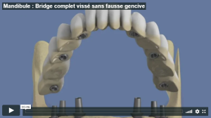 Mandibule : Bridge complet vissé sans fausse gencive
