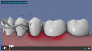 Traitement ultrasonique de la parodontite