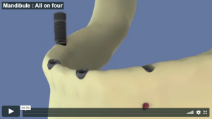 Mandibule : All on four