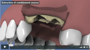 Extraction et comblement osseux