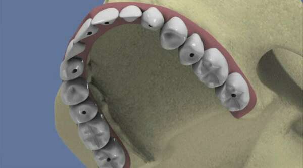 Maxillaire complet et traitement implantaire pour un bridge fixe vissé