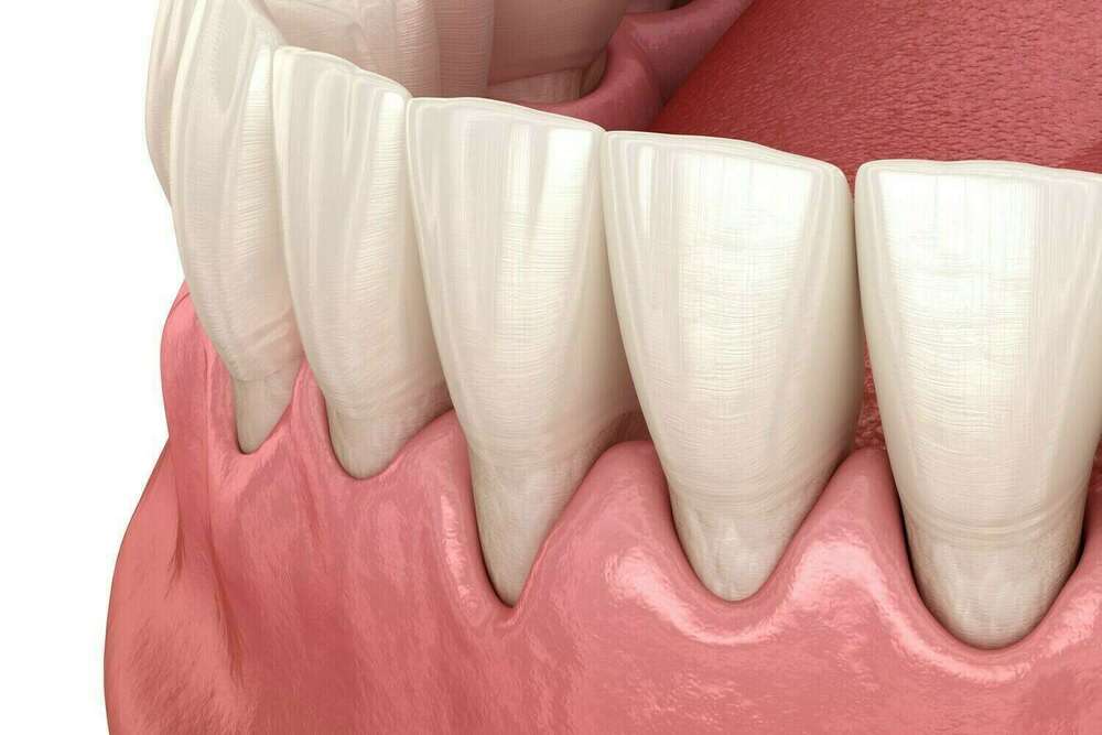 Rétraction des gencives suite à une maladie parodontale