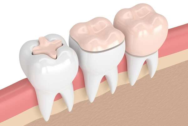 Inlay et onlay, une technique conservatrice