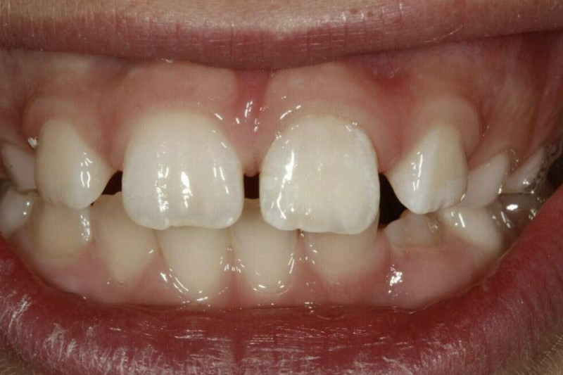 Accidents domestiques - Cas cliniques cabinet dentaire à Gap