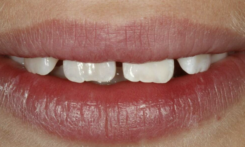 Accidents domestiques - Cas cliniques du Dr. Adrien COURONNE à Gap