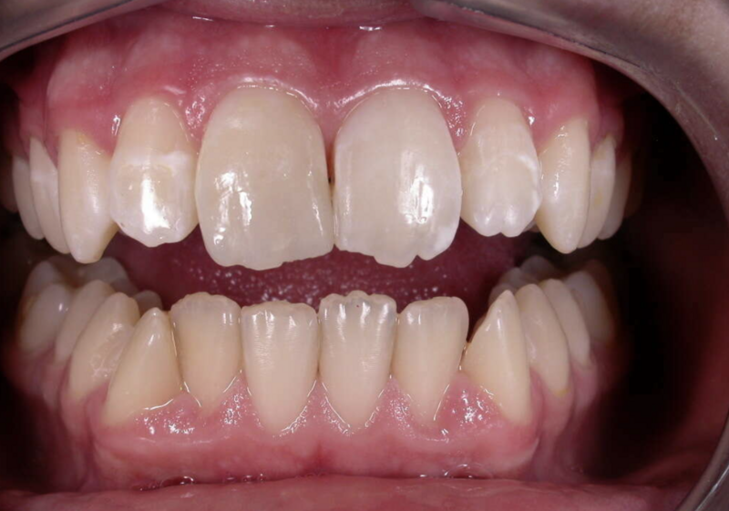 Accidents domestiques -  Cas cliniques du Dr. Adrien COURONNE, chirurgien-dentiste à Gap