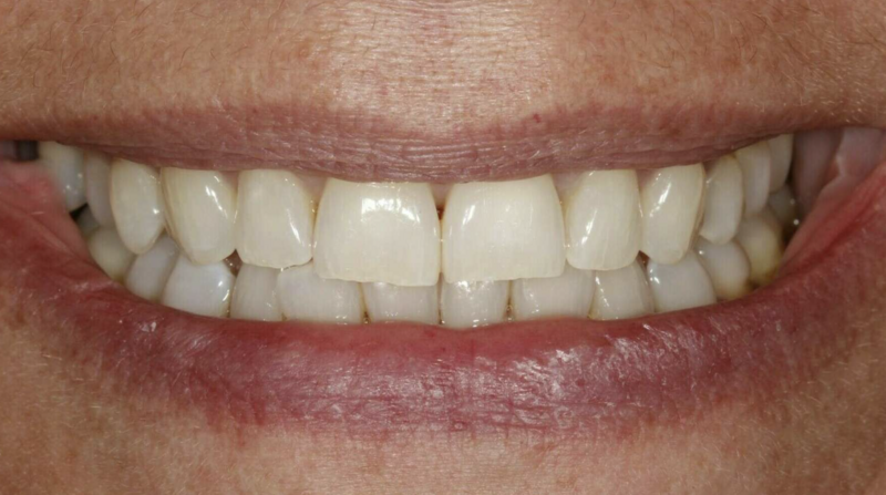 Éclaircissement - Cas cliniques du cabinet dentaire à Gap