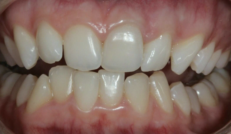 Éclaircissement - Cas cliniques du Dr. Adrien COURONNE, chirurgien-dentiste à Gap