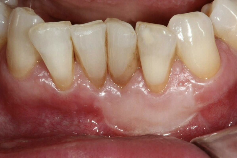 Greffe gingivale - Cas cliniques du Dr. Adrien COURONNE à Gap