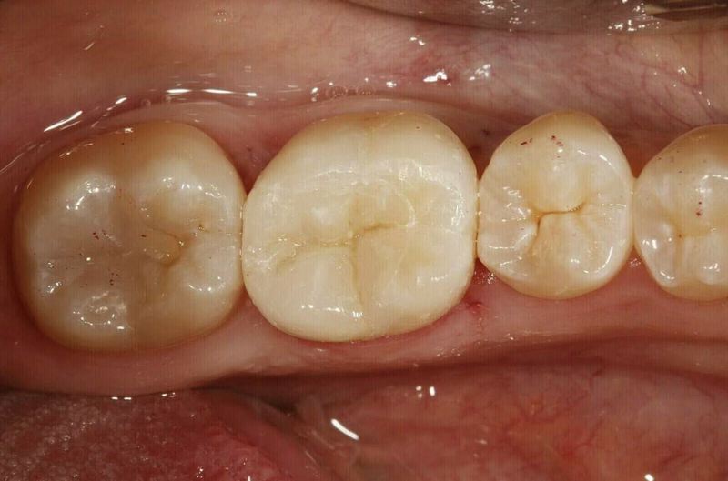 Onlay - cas clinique Dr COURONNE à Gap