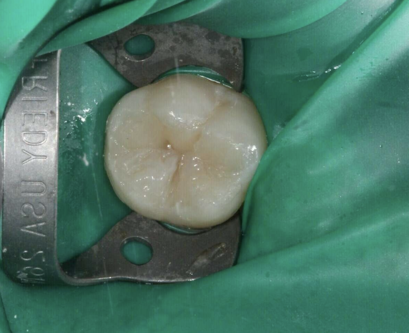 Traitement des caries au cabinet du Dr COURONNE à Gap