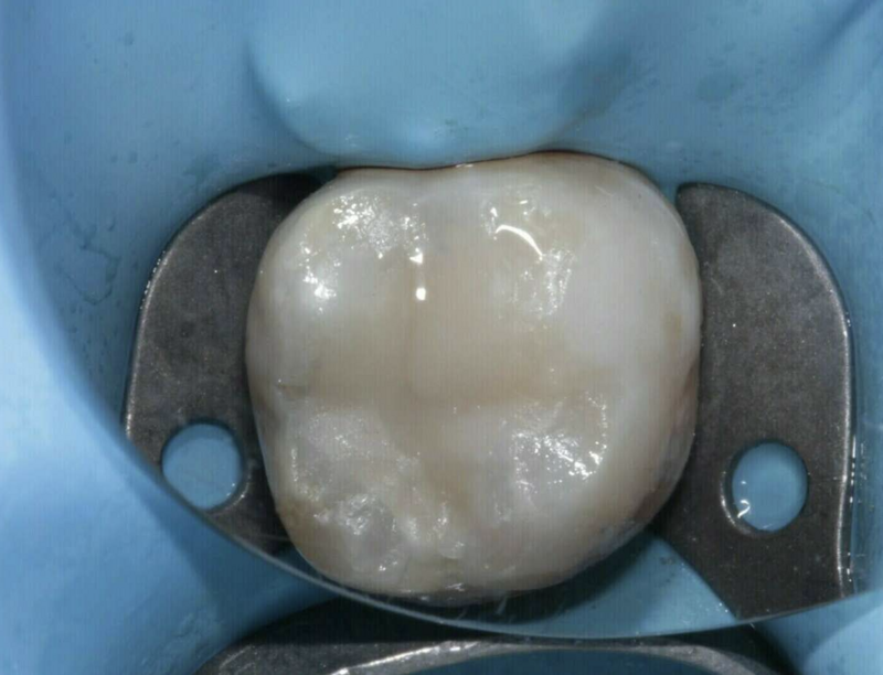 Carries - cas clinique - Dr COURONNE à Gap