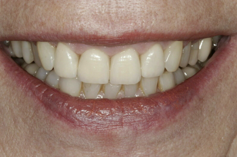 Facettes - cas clinique Dr COURONNE à Gap