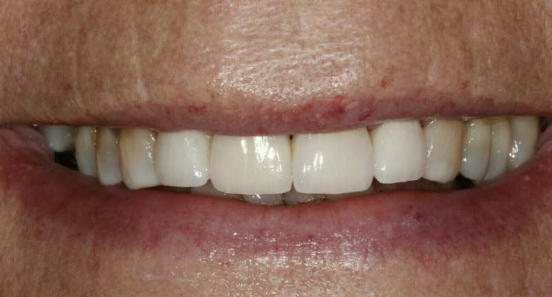 Esthétique du sourire - cas clinique Dr COURONNE à Gap