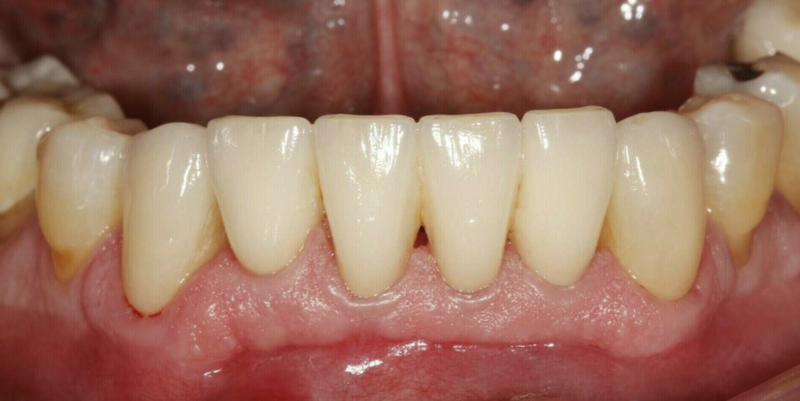 Esthétique dentaire - cas clinique Dr COURONNE à Gap