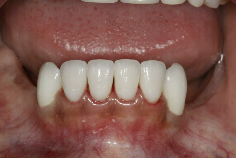 Zircone - traitement au cabinet du Dr COURONNE à Gap