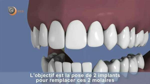 Comblement de sinus par voie latérale et implantation simultanée