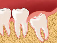 Les dents de sagesse