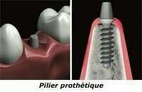 LES DIFFERENTES PIECES D’UN IMPLANT - DR BODIN, DENTISTE A ANTIBES