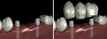 LA PROTHESE SUR IMPLANTS - DR BODIN, DENTISTE A ANTIBES