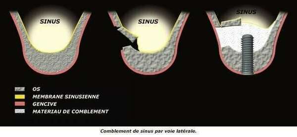 LES COMBLEMENTS DE SINUS OU SINUS LIFT PAR VOIE LATERALE - DR BODIN, DENTISTE A ANTIBES