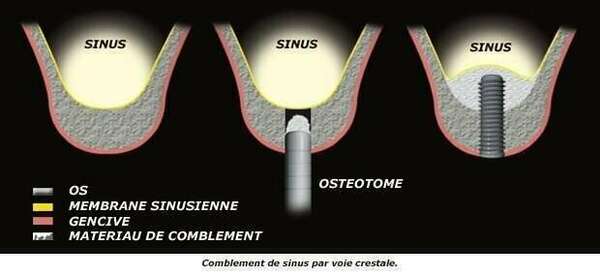 LES COMBLEMENTS DE SINUS OU SINUS LIFT PAR VOIE CRESTALE - DR BODIN, DENTISTE A ANTIBES